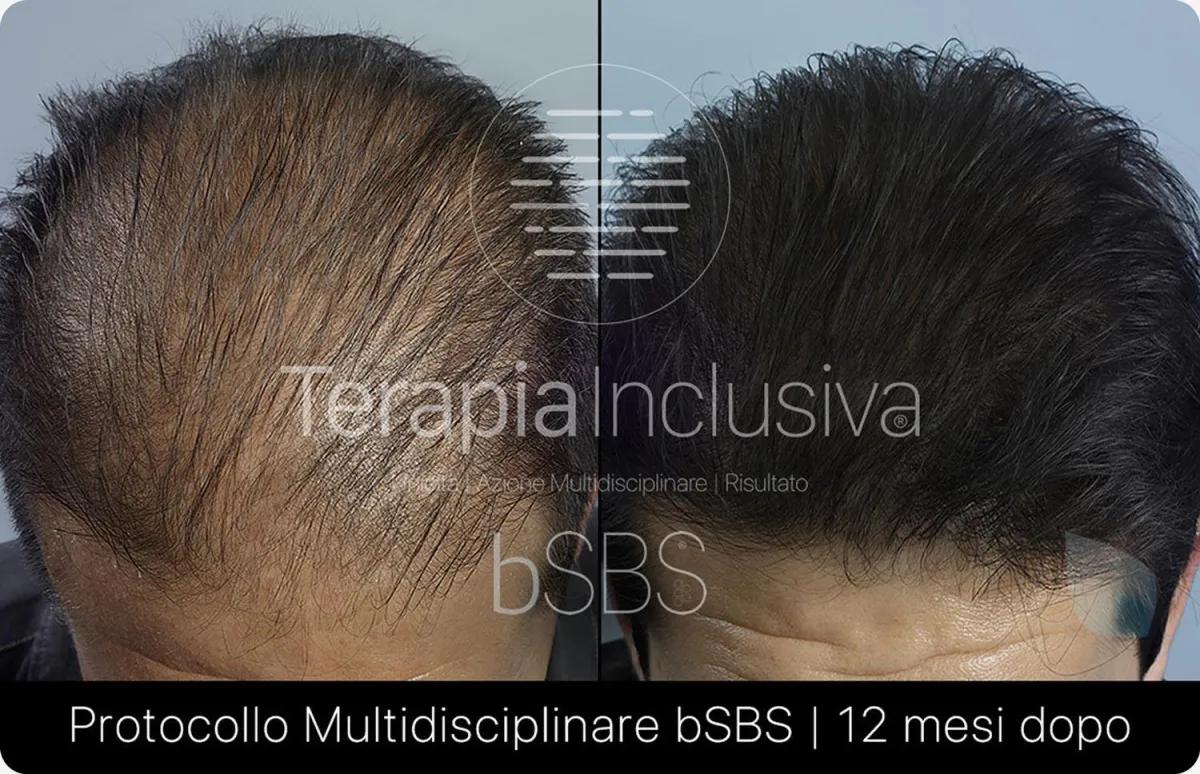 Terapia Incusiva bSBS