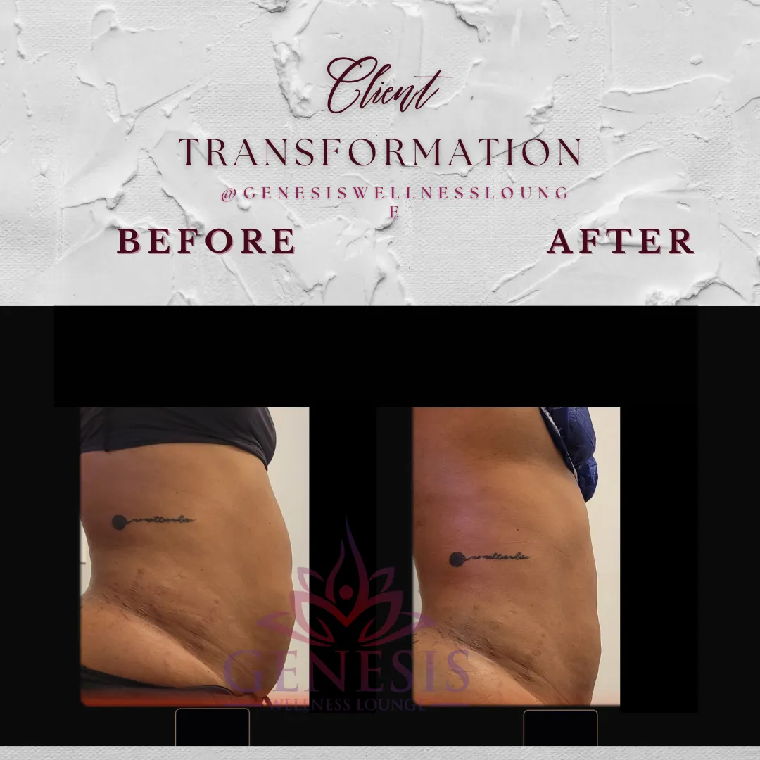 Legs with low level laser therapy, laser lip on thighs