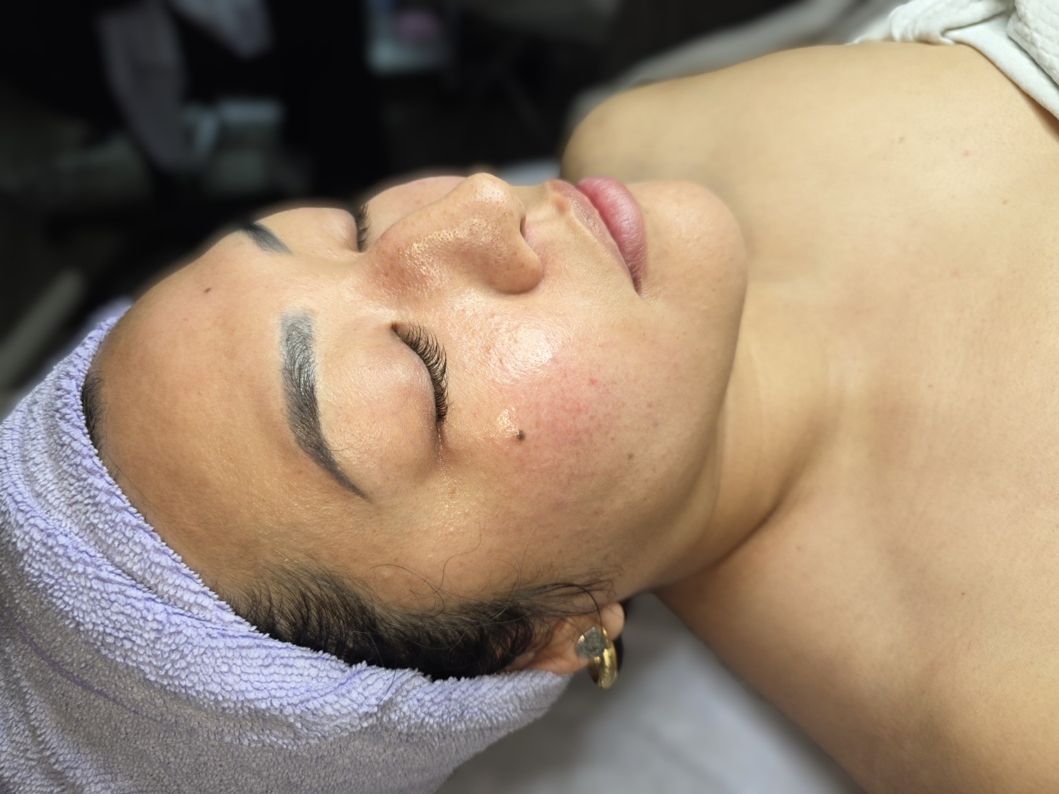 Skin rejuvenation treatment before and after result