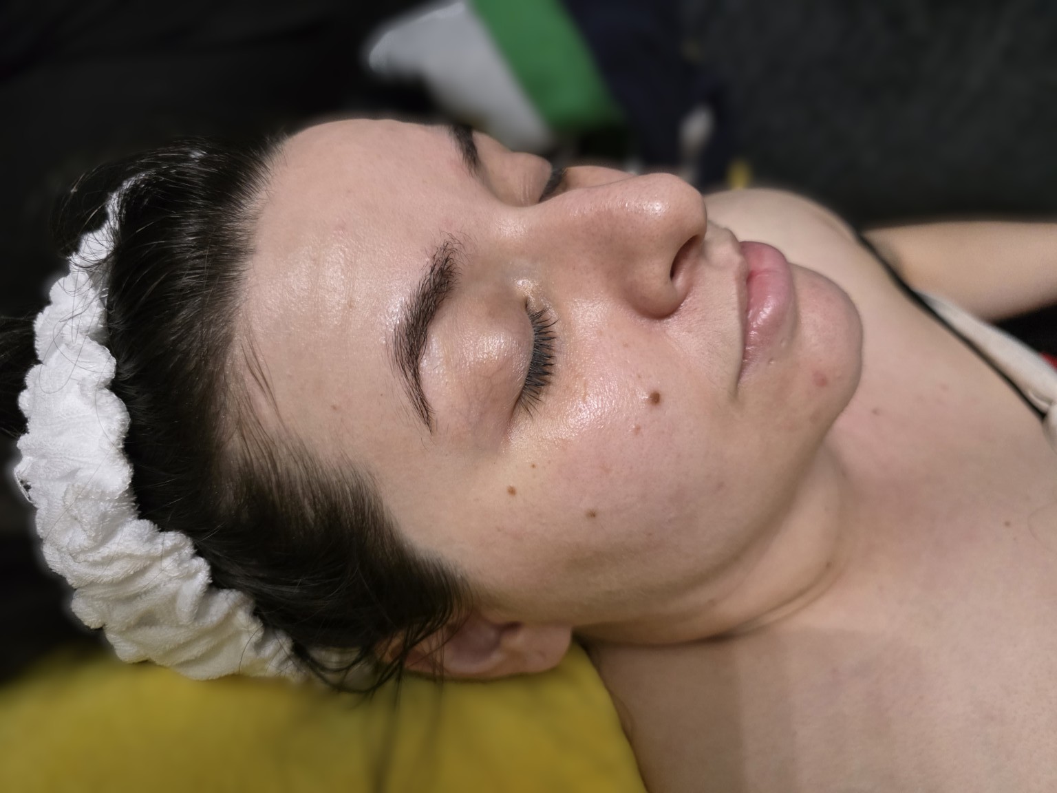 Lip filler before and after result