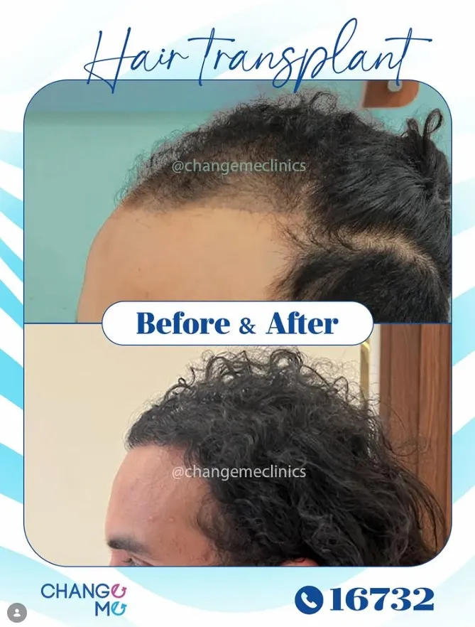 Before and after photo card of beauty and wellness treatment, showing skin rejuvenation results