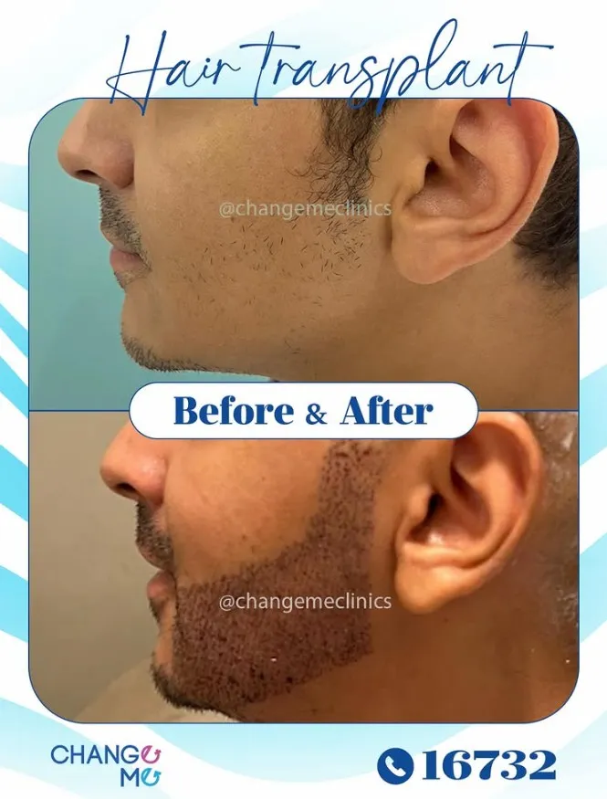 Before and after photo card of beauty and wellness treatment, showing facial aesthetic results