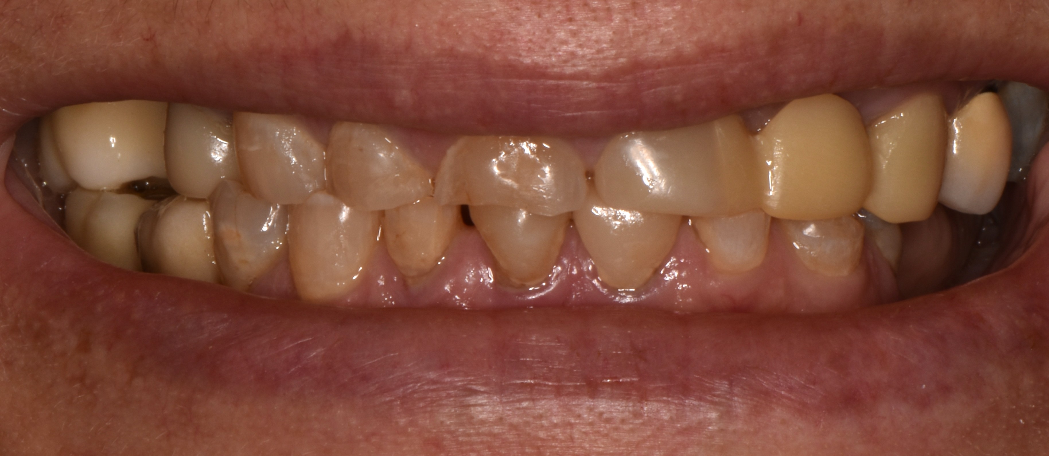 Cosmetic dentistry before and after