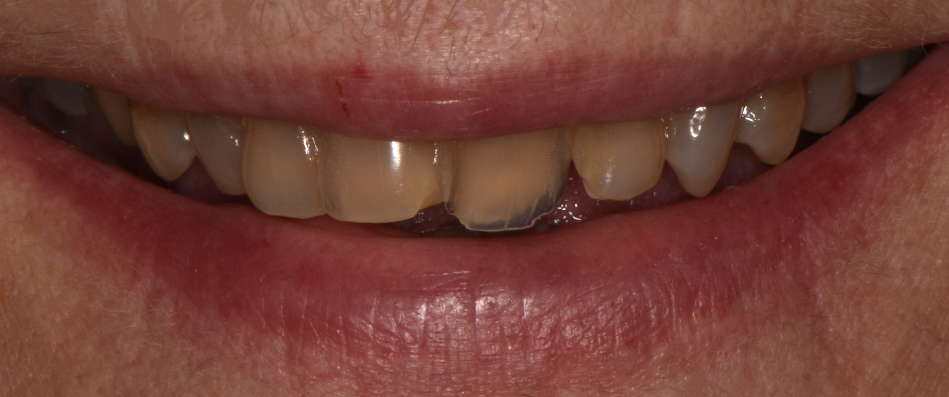 Cosmetic dentistry before and after