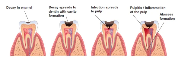 Tooth Decay and Infection Diagram
