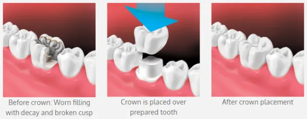 Tooth Crowning