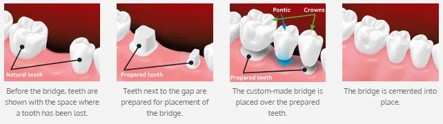 Tooth Bridge