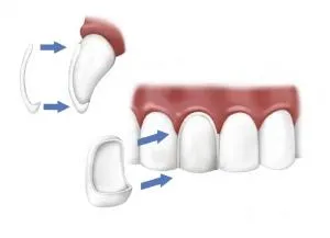 Tooth Veneer Diagram