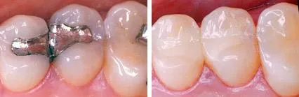 Dentistry teeth fillings