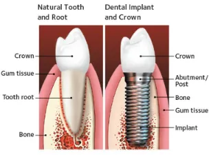 Tooth vs. Dental Implant  DIagram