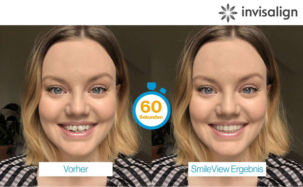 Invisalign transparente Zahnschiene fuer unsichtbare Zahnkorrektur
