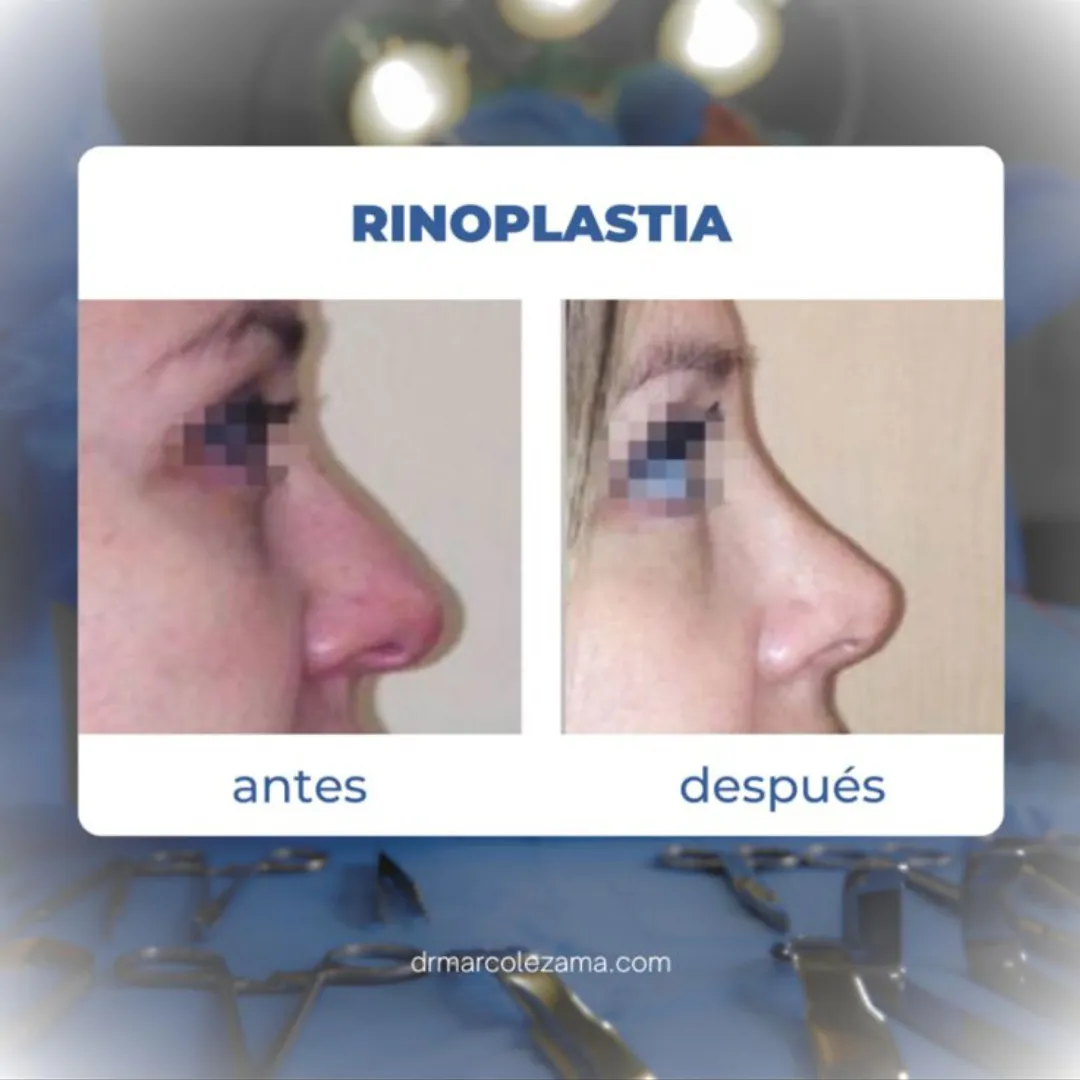 Paciente masculino antes y después de corrección de ginecomastia