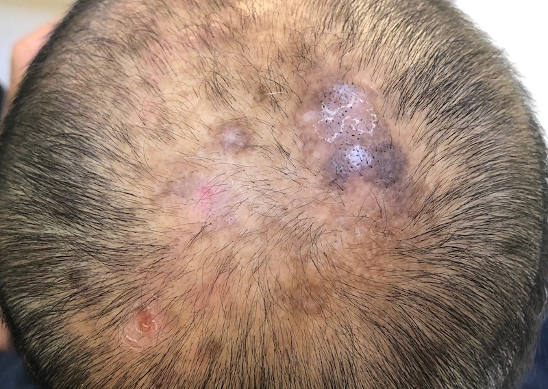Alopecia Cicatricial | Kerri Jarrett, Trichology and Epigeentics