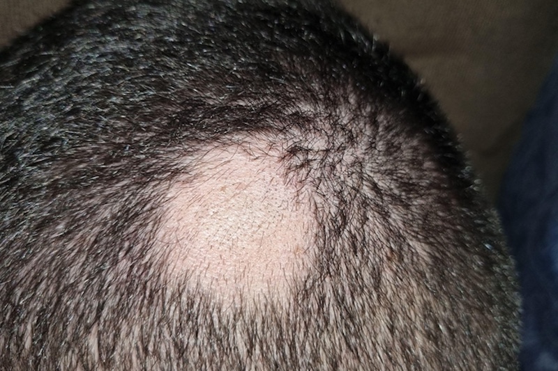 Alopecia Areata | Kerri Jarrett, Trichology and Epigeentics