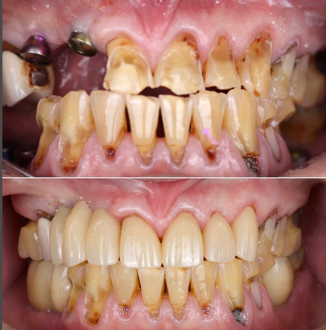 [AFTER — Patient Smile Photo]