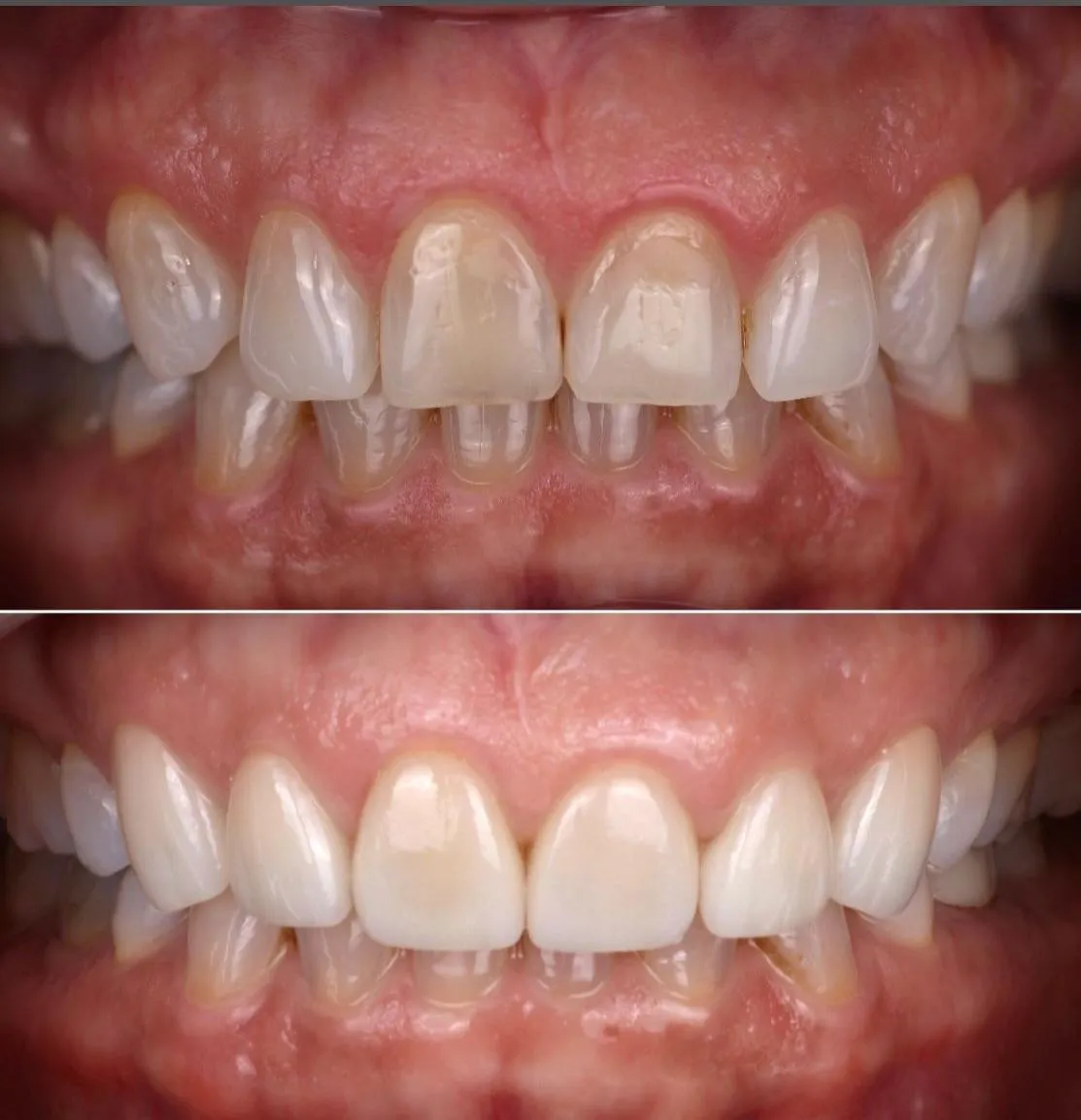[AFTER — Patient Smile Photo]