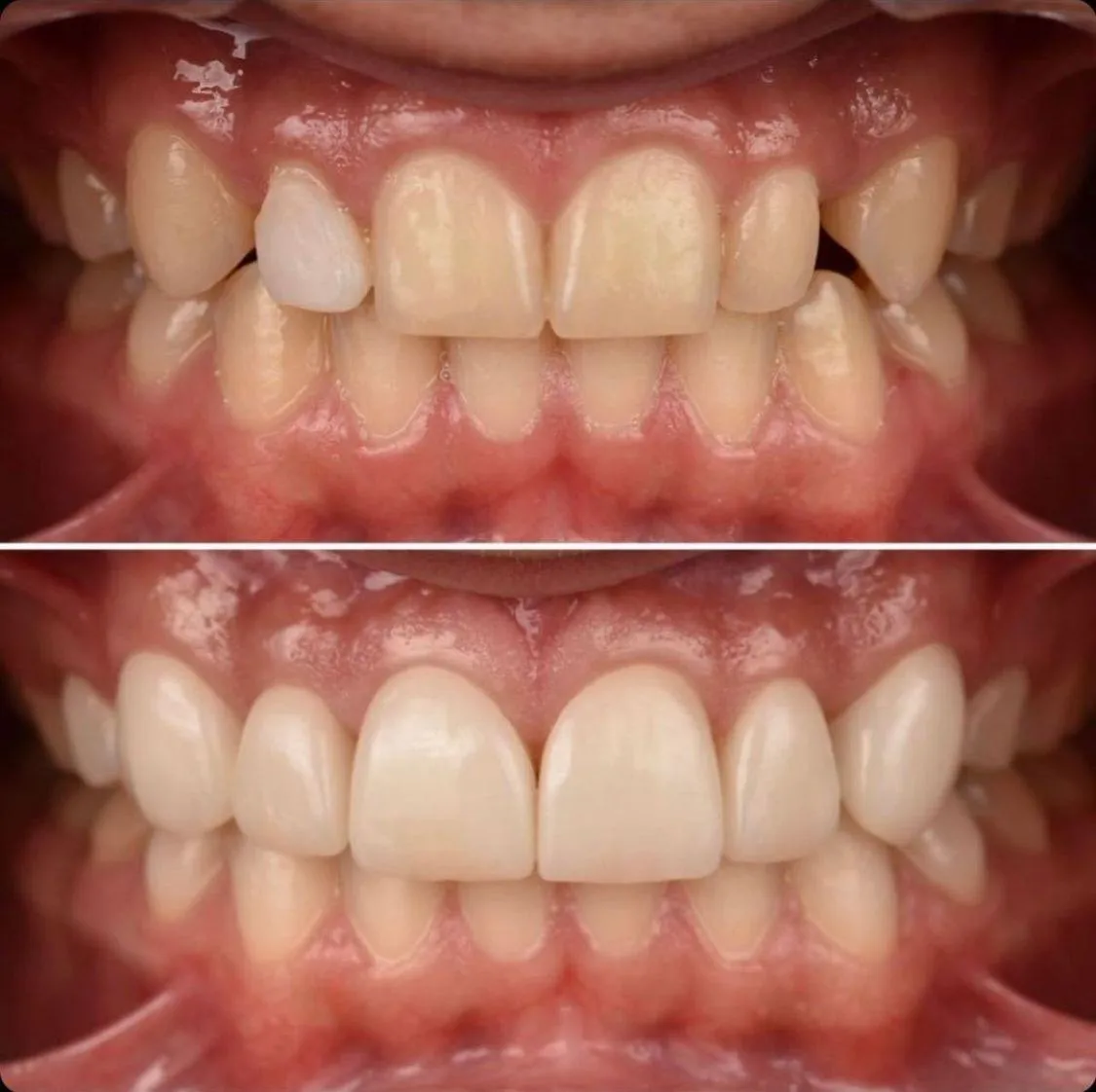 [AFTER — Patient Smile Photo]
