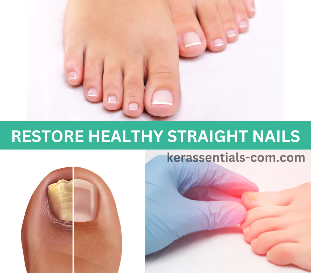 kerassentials for toenail fungus