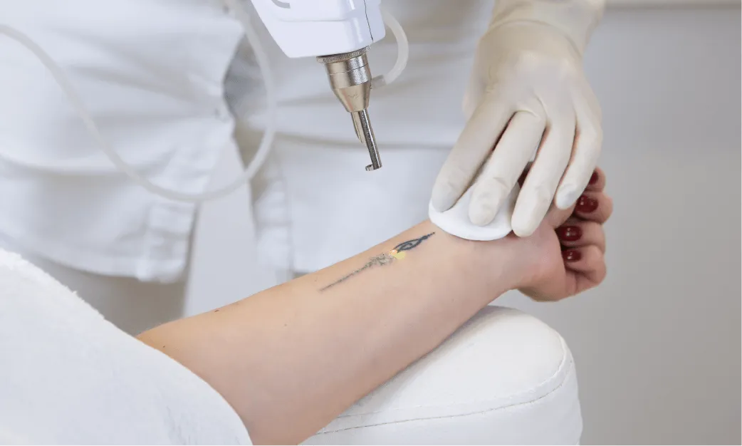 Tattoo Removal with Q-Switched Laser