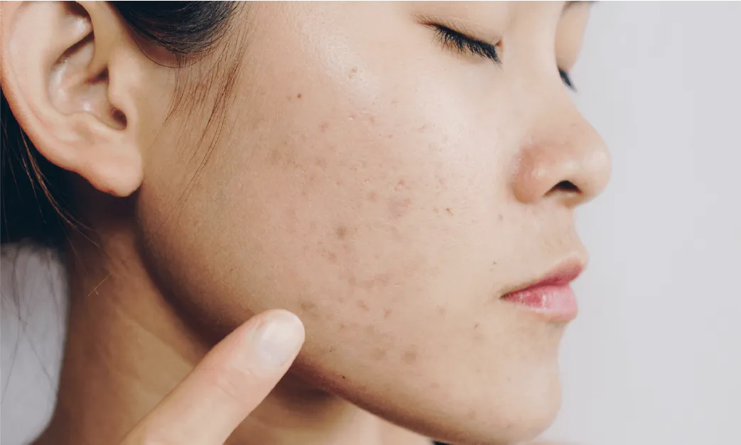 Acne Scar Rejuvenation