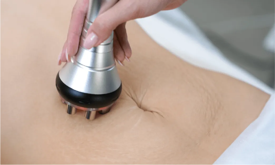 Body Contouring with Radio Frequency