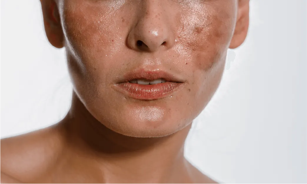 Woman Face with Melasma