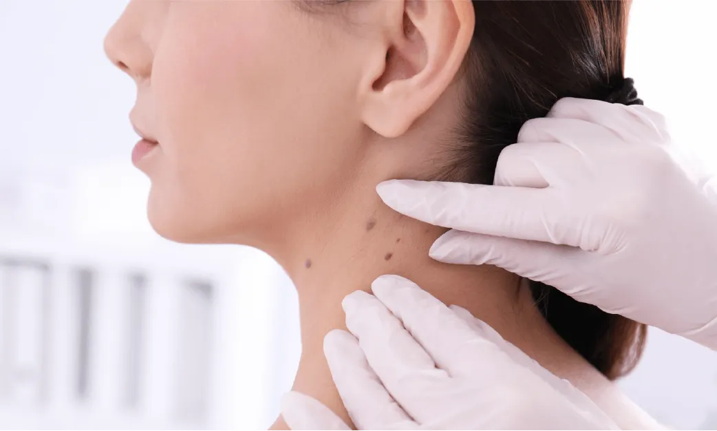 Pigmented Lesions on Woman's Neck