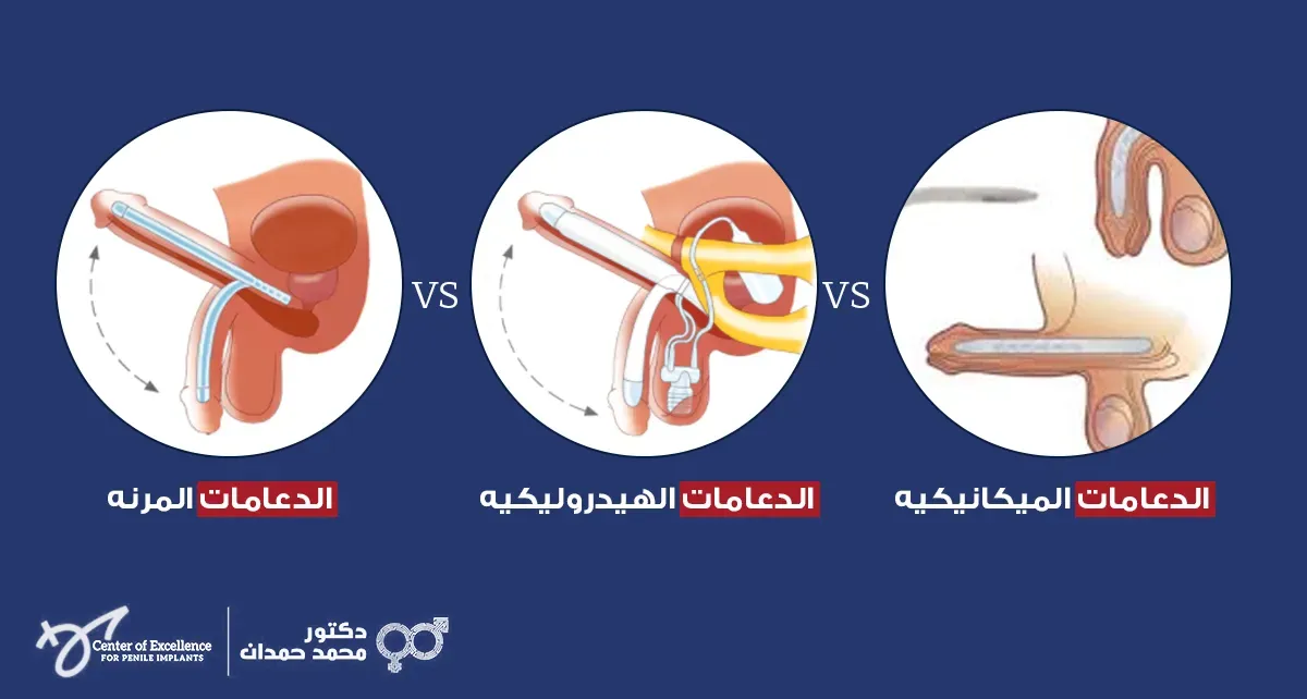 أنواع الدعامات للانتصاب: الدعامات المرنة، الهيدروليكية، والميكانيكية، رسومات توضيحية لكل نوع، شرح دكتور محمد صمدات.
