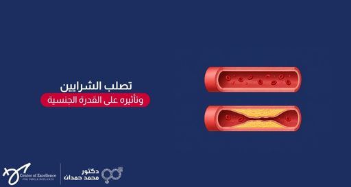 رسم توضيحي لشريانين يوضحان تدفق الدم؛ الشريان العلوي سليم ومفتوح، والشريان السفلي مصاب بضيق وتراكم للدهون (تصلب الشرايين)، بجانبهما خلفية زرقاء داكنة تحتوي على نص باللغة العربية: "تصلب الشرايين وتأثيره على القدرة الجنسية"، بالإضافة إلى شعار "دكتور محمد حمدان".