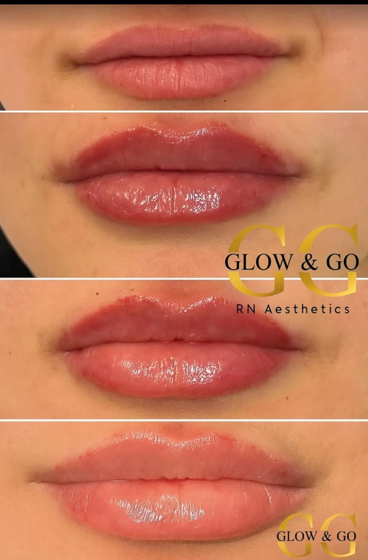Before and after: a woman in her 40s, left image shows mild lines, right image shows smoother, radiant skin post-treatment, both in the same elegant medspa setting with gold accents and soft lighting.