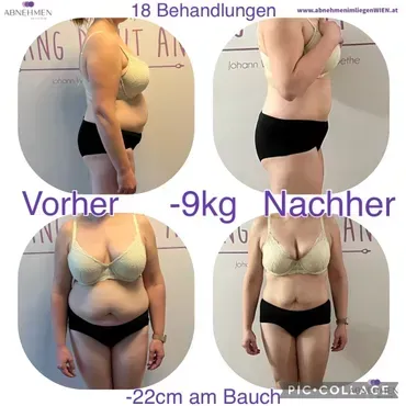 Kathi 39 nach 18 Behandlungen vorher nachher