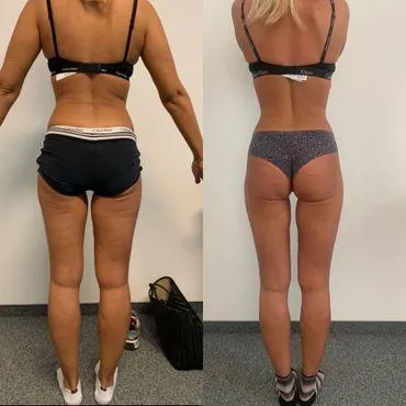 Tina (29) nach nur 9 Behandlungen vorher nachher