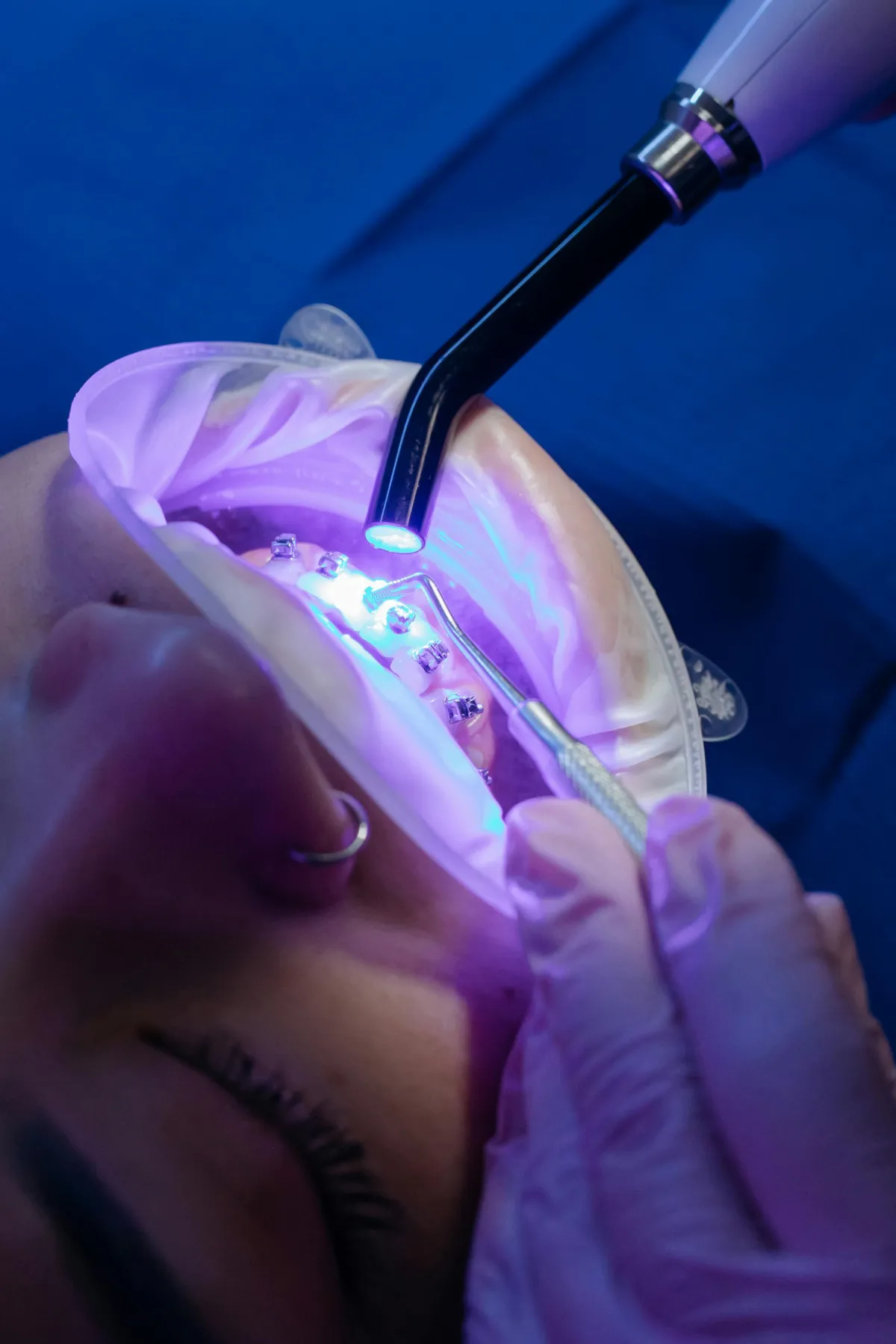 Image of Braces being glued on by a dentist