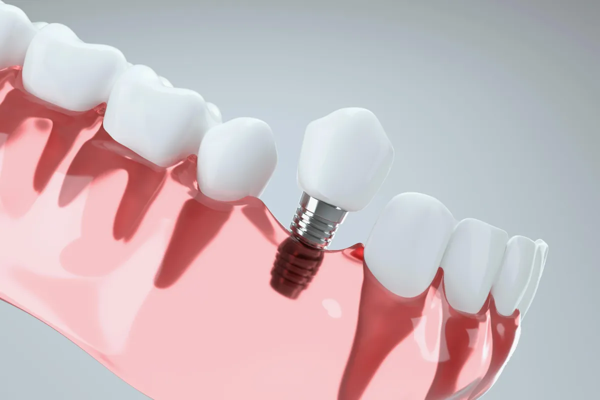 Demonstration of a dental implant single tooth
