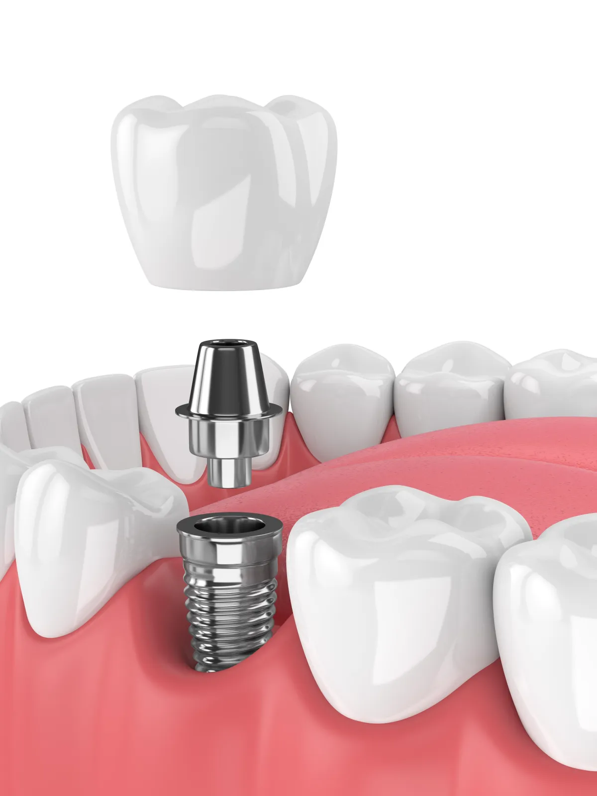 single dental implant tooth diagram