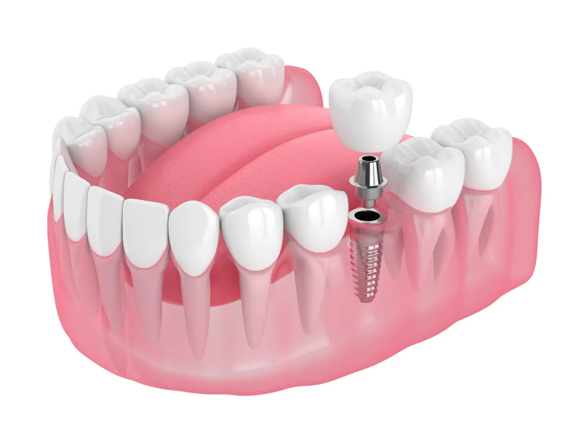 diagram of a dental implant