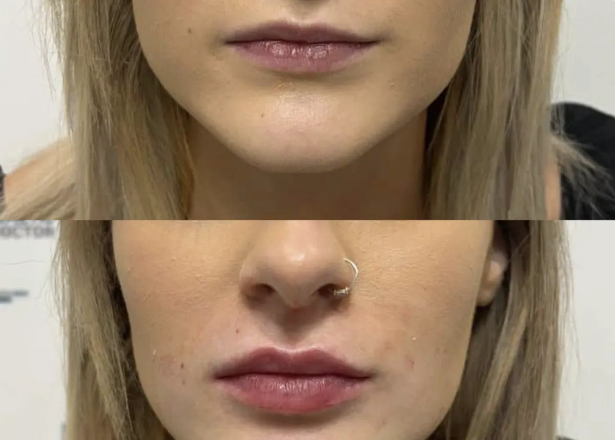 Aesthetic Injectables