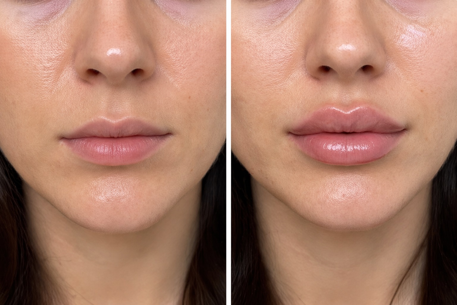 Before and after dermal filler treatment enhancing lip volume and facial contours.