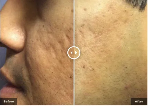 RF Microneedling before and after: skin texture improvement and reduced acne scarring.