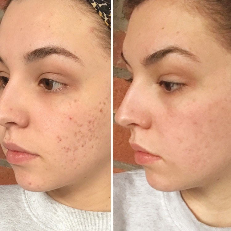Botox treatment