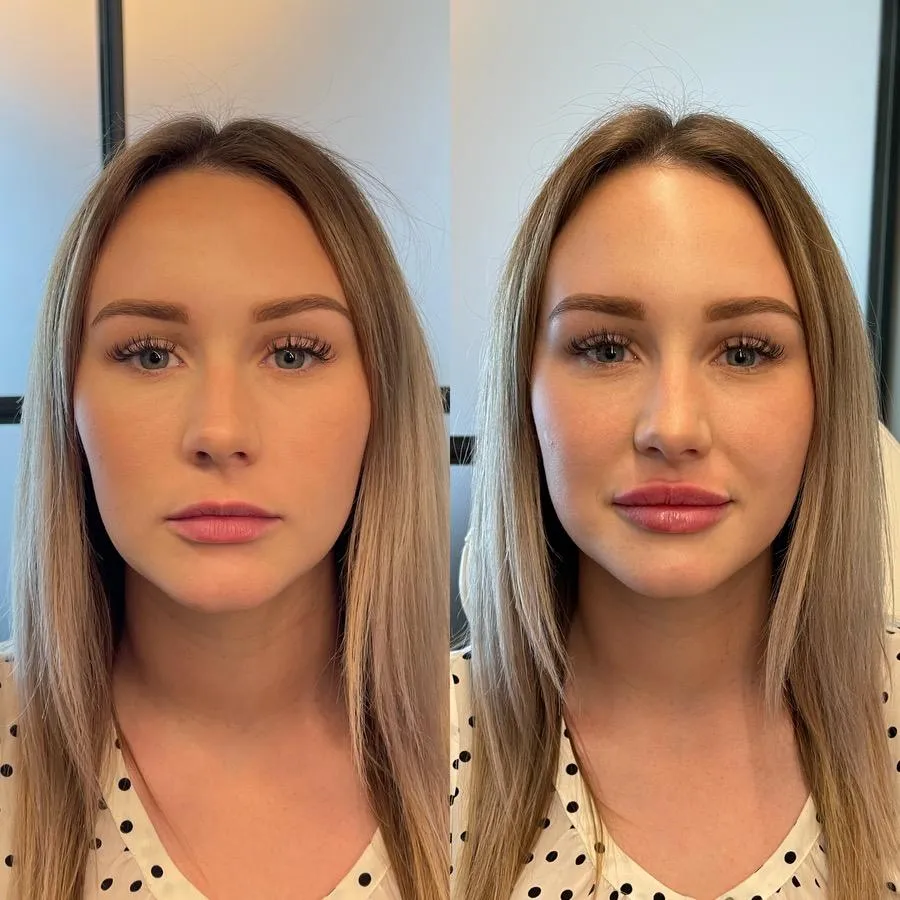 Before and after dermal filler treatment demonstrating facial volume restoration and youthful contours.