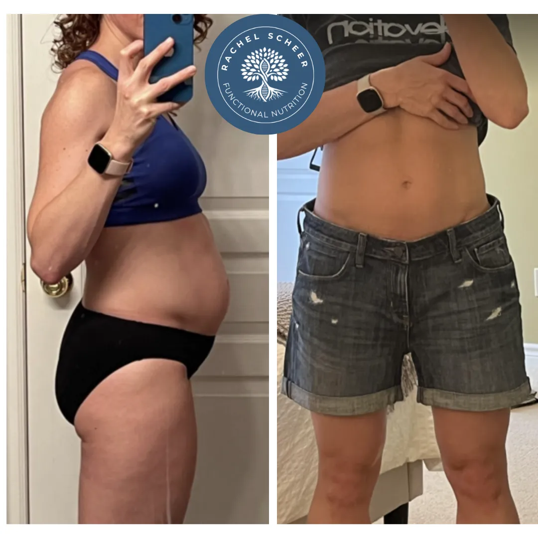 Client before and after resolving methane-dominant SIBO