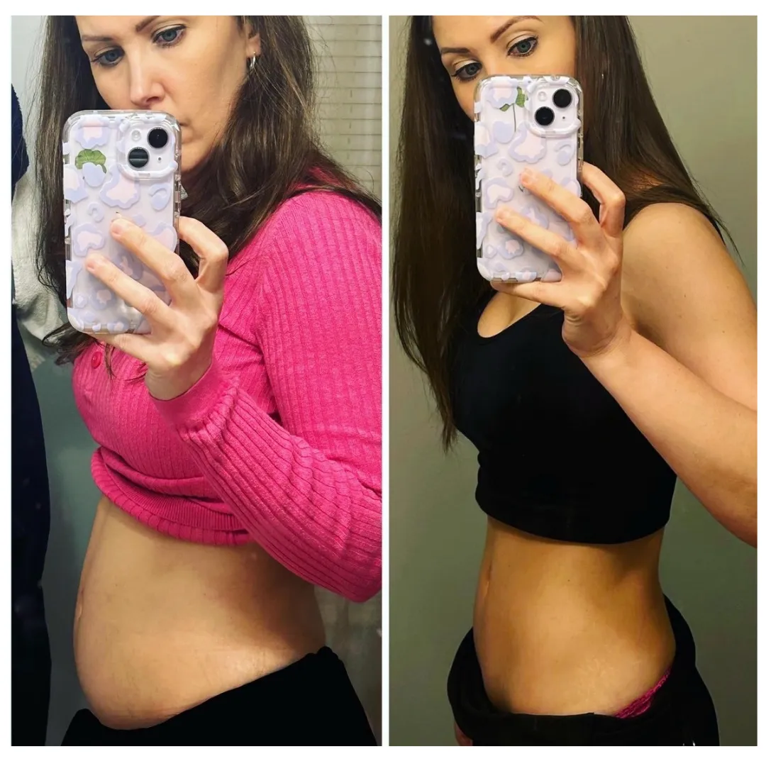 Client before and after resolving low stomach acid