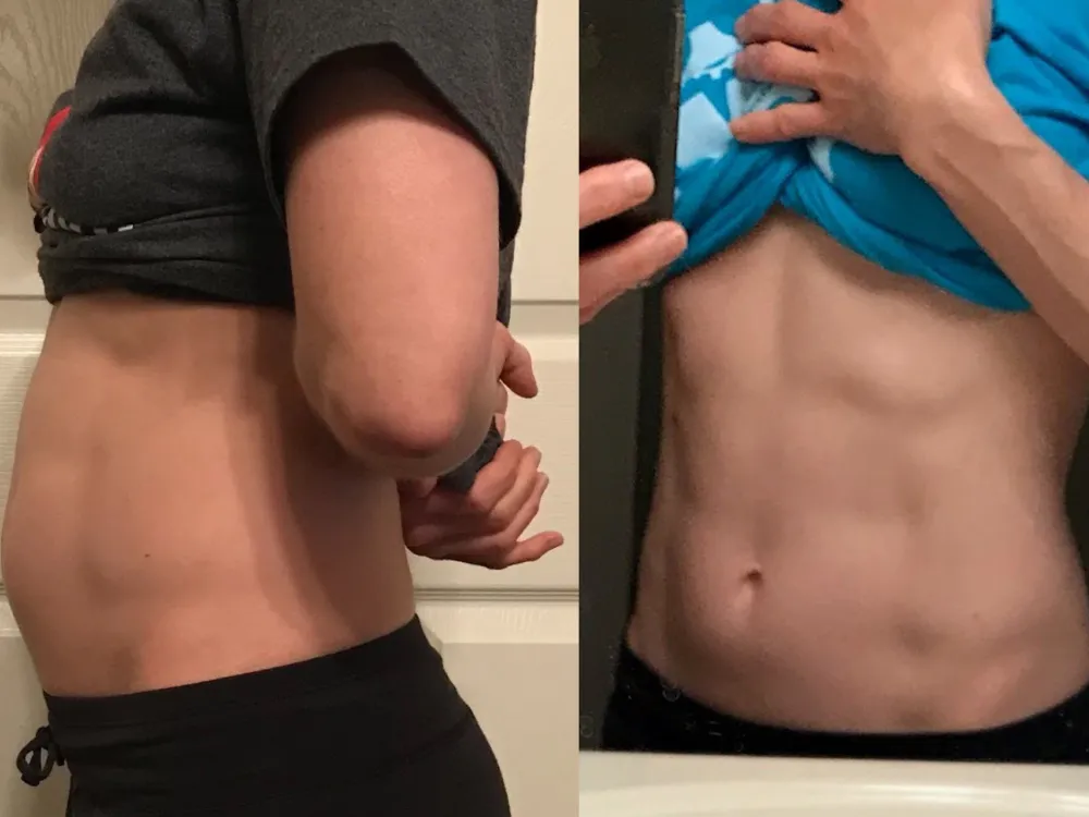 Client before and after resolving methane-dominant SIBO