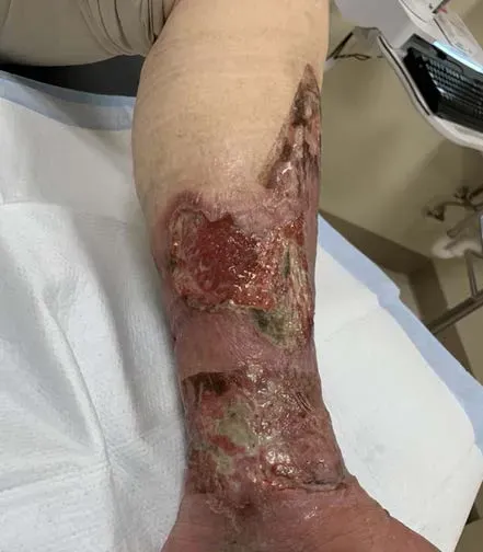 Wound on leg image