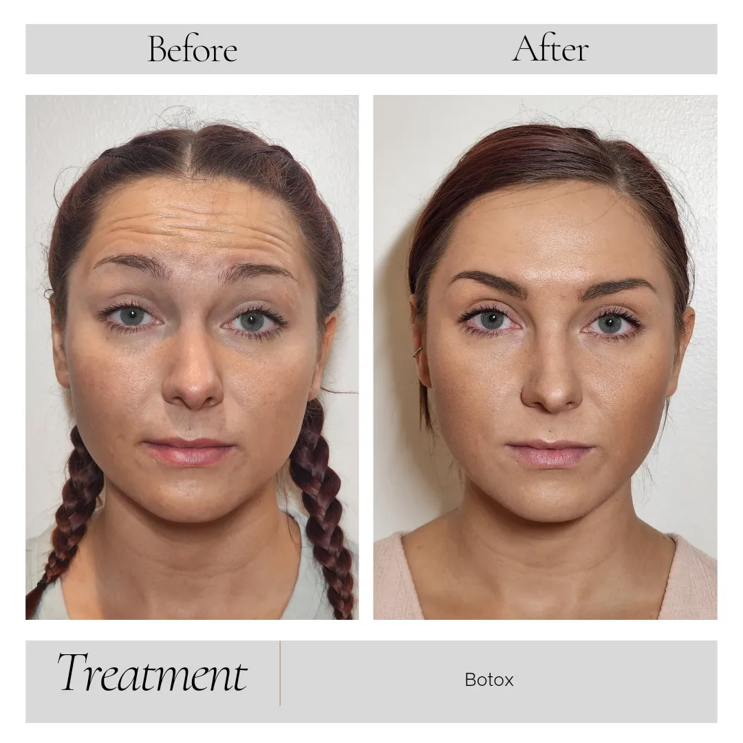 Botox in Kansas City, MO