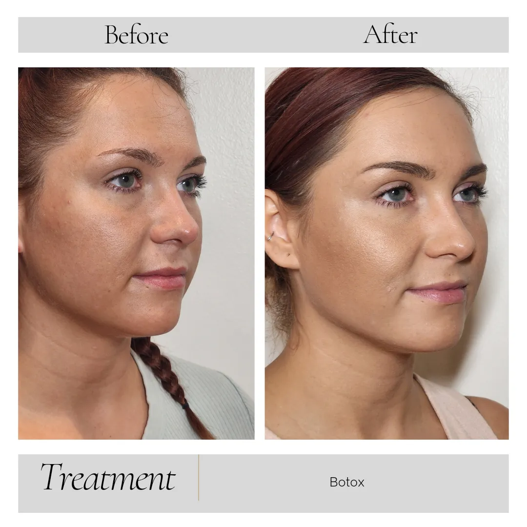 Dermal Fillers in Kansas City, MO