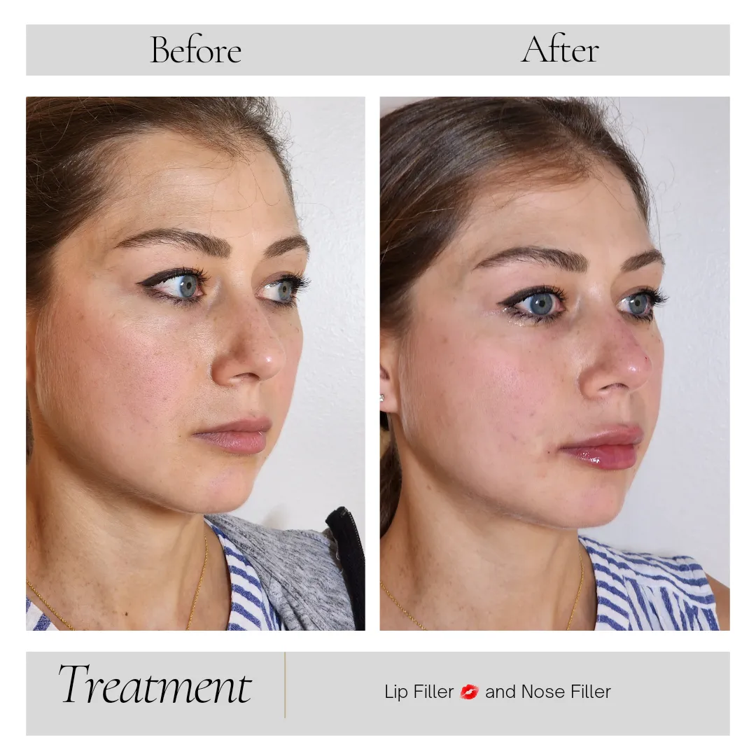 Dermal Fillers in Kansas City, MO