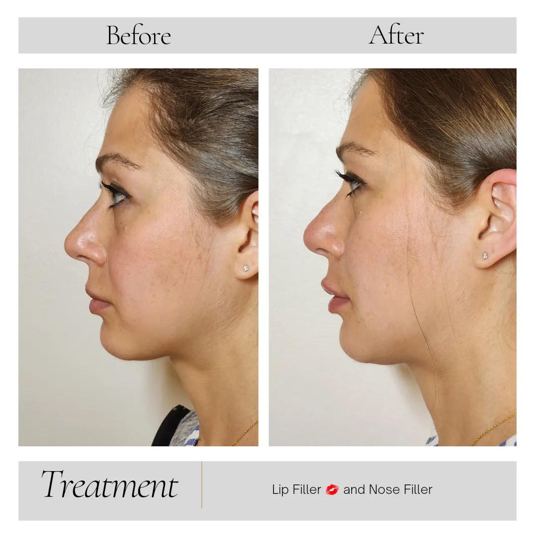 Facial Balancing in Kansas City, MO