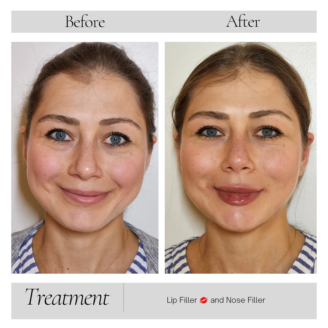 Botox in Kansas City, MO